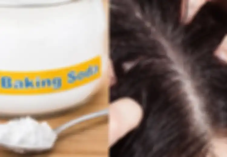 Kelebihan Minyak di Rambut Hingga Sebabkan Ketombe, Coba Gunakan Baking Soda untuk Serap Minyak Berlebihan itu, Begini Cara Pakainya, dan  Fungsi Lain Bahan Dapur Ini!