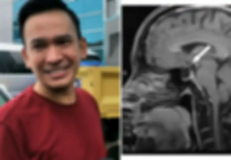 Ruben Onsu Pernah Merasa Sangat Kedinginan, Kaku Badannya  Hingga Tidak Bisa Bergerak, Hasil Diagnosis Dokter Mengidap Penyakit Empty Sella Syndrome, Penyakit Apa Itu dan Kapan Harus Waspada?
