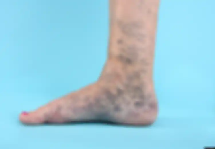 Bagaimana Menghilangkan Varises di Kaki?