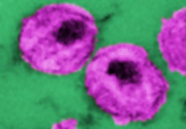 Meminimalkan Peradangan Sel untuk Antisipasi HIV