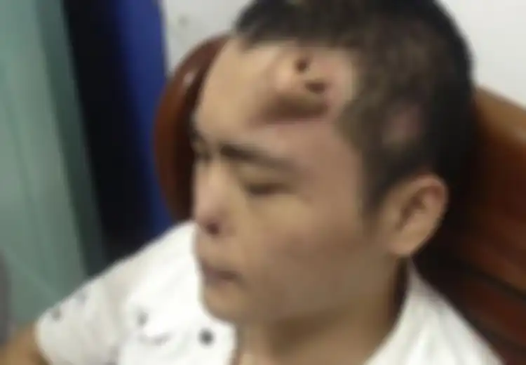 Hidung Lelaki Ini Terpaksa Diletakkan di Dahi