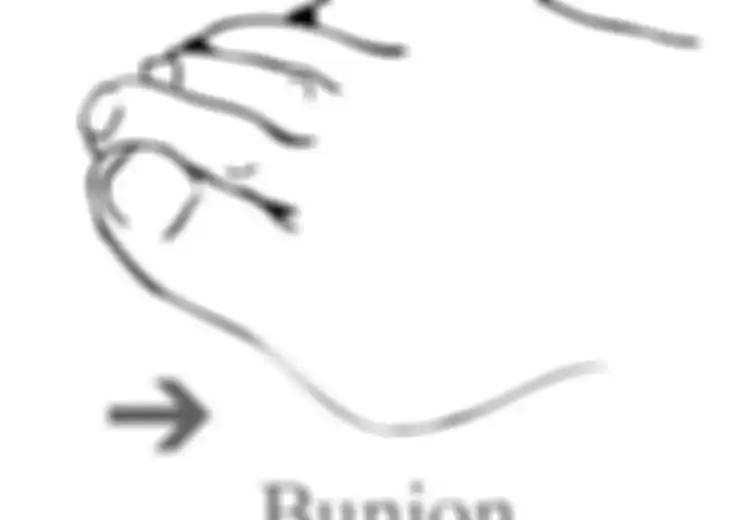 Bunion Bukan Karena Sepatu