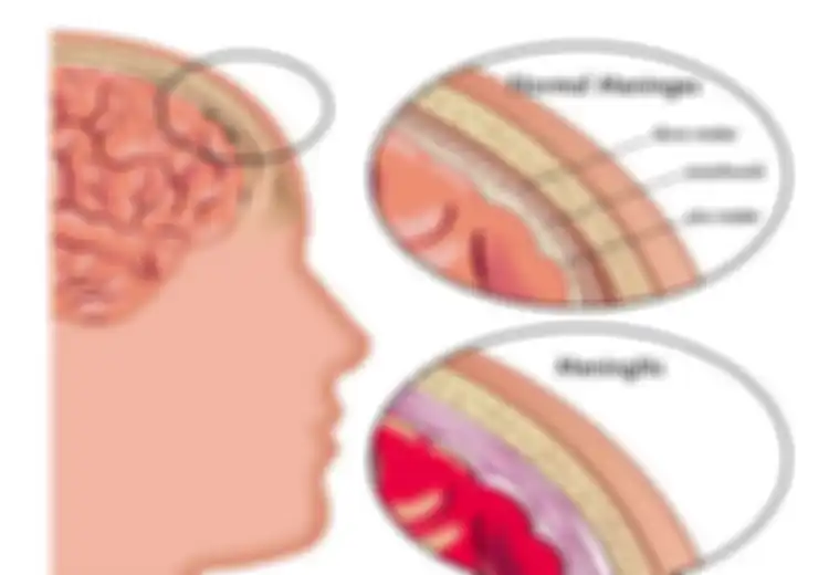 Meningitis pada Anak Pengaruhi Prestasi