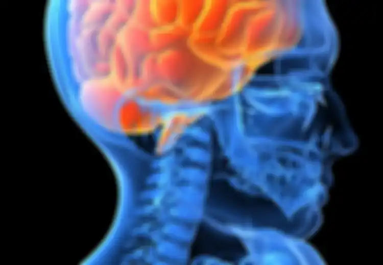 Stroke Ringan, Otak Pun Rusak