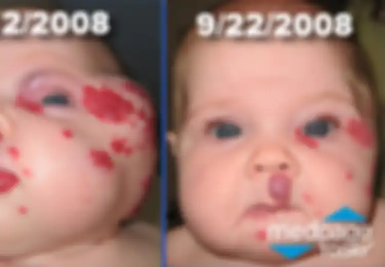 Propranolol, Harapan Baru Hemangioma Anak