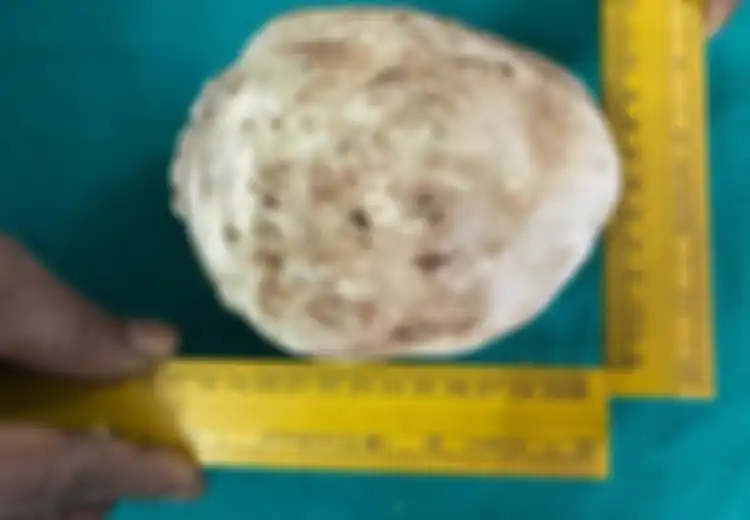 Perutnya Mendadak Sakit, Ternyata Ada Batu Seberat 1,4 kg Dalam Kantung Kemih Pria Asal India Ini