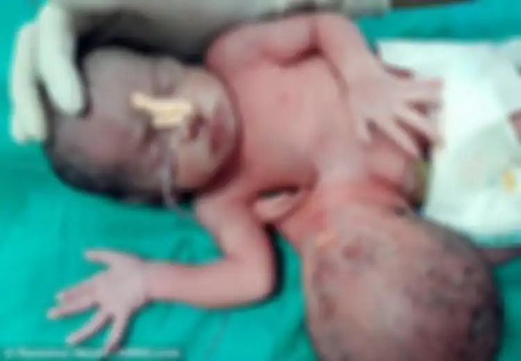 Suami Istri Ini Tetap Merasa Sedih Meski Dokter Berhasil Lepaskan ‘Parasit’ dari Tubuh Bayinya
