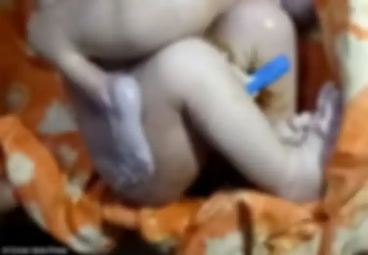 Bayi Kembar Parasit dengan Kaki dan Kelamin Ganda Ini Nyaris Dibuang ke Sungai, Kini Ia Sukses Menjalani Operasi