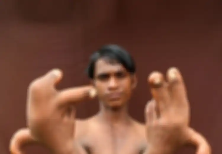 Kasihan! Gara-gara Punya Jari-jari yang Besar dan Panjang, Bocah Ini Dijuluki ‘Iblis’