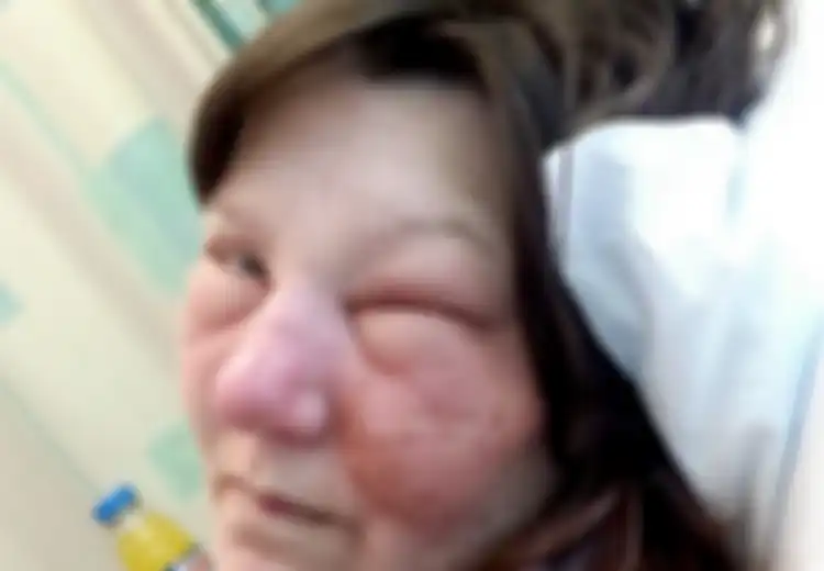 Untuk Jadi Perhatian, Wajah Perempuan Ini Jadi Bengkak Hanya Gara-Gara Goresan Kecil di Hidung Saat Berkebun