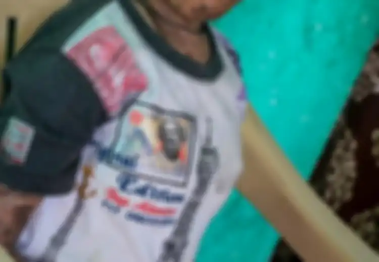 Gadis India dengan Kulit Bersisik Ini Mengingatkan Kita pada Sosok Jambunada di Serial Mahkota Mayangkara
