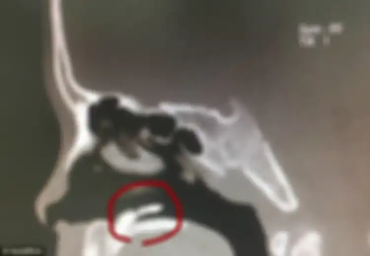 Gara-gara Ada yang Tumbuh Sembarangan Hidung Wanita Ini Sering Alami Pendarahan