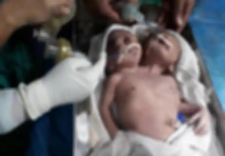 Sedih, Bayi Kembar Siam Dengan Dua Kepala dan Satu Tubuh Ini Hanya Bisa Bertahan Hidup Selama 24 Jam Saja
