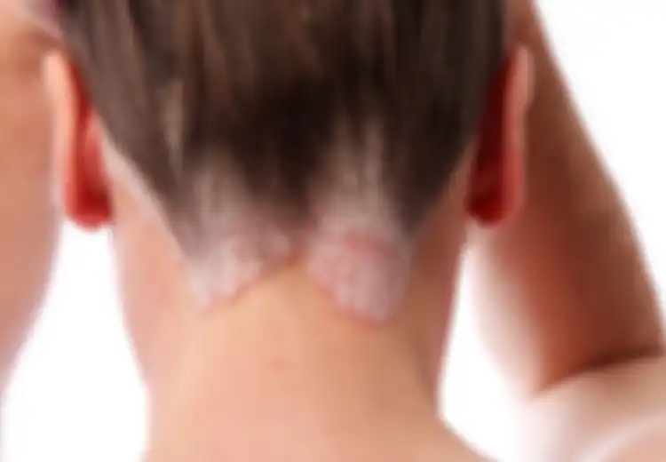 Hati-hati! Ketombe yang Sulit Hilang dan Kulit Kepala Bersisik Bisa Jadi Tanda Psoriasis