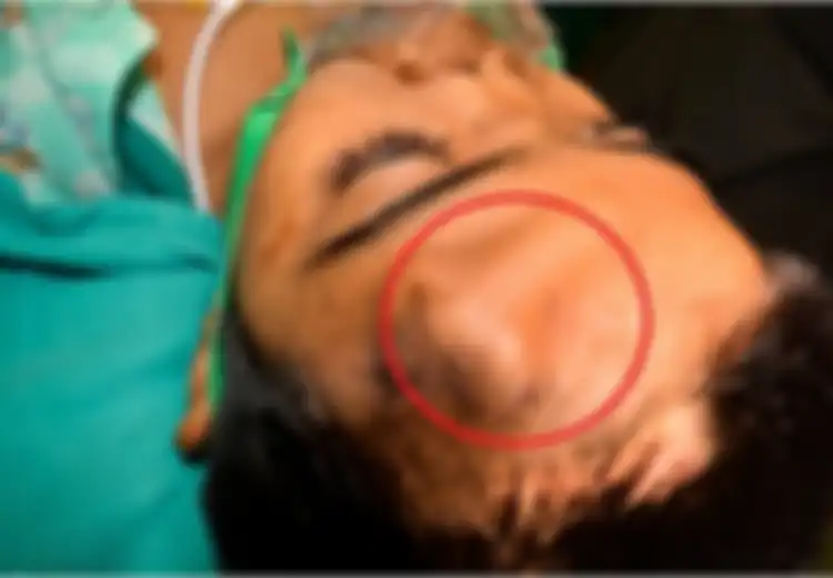 Hidup Bocah di India Ini Terselamatkan Setelah Ada Hidung yang Tumbuh di Dahinya