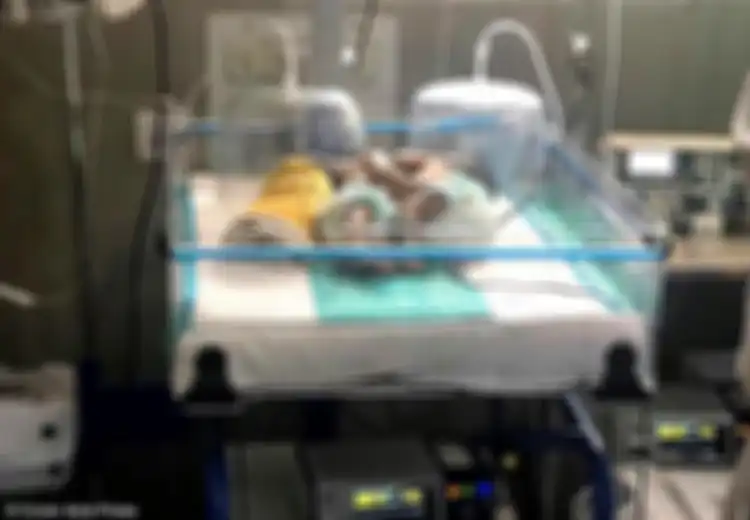 Tidak Pernah Cek Kehamilannya, Wanita India Ini Melahirkan Bayi Kembar Siam yang Jantung dan Hatinya Menyatu