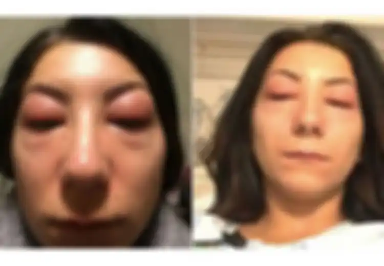 Ngeri! Niat Hati Ingin Menyambung Bulu Mata, Wanita Ini Jutsru Alami Alergi Parah
