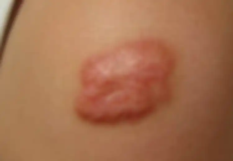 Keloid Jinak tapi Mengganggu, Bila Memang Tidak Mengganggu Ya Sudah Berdamai Saja!