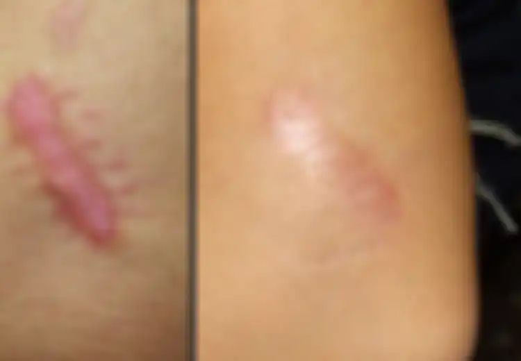 Punya Keloid yang Mengganggu Penampilan? Atasi dengan 6 Bahan Alami nan Ampuh Ini