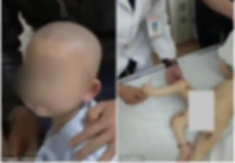 Lahir dengan Tiga Kaki, Bayi 11 Bulan Ini Menjalani Prosedur Operasi yang Rumit Hampir 10 Jam