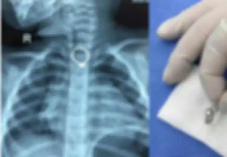Peringatan untuk Para Orang Tua, Balita Ini Menelan Cincin Berlian Saat Ibunya Sedang Tidur
