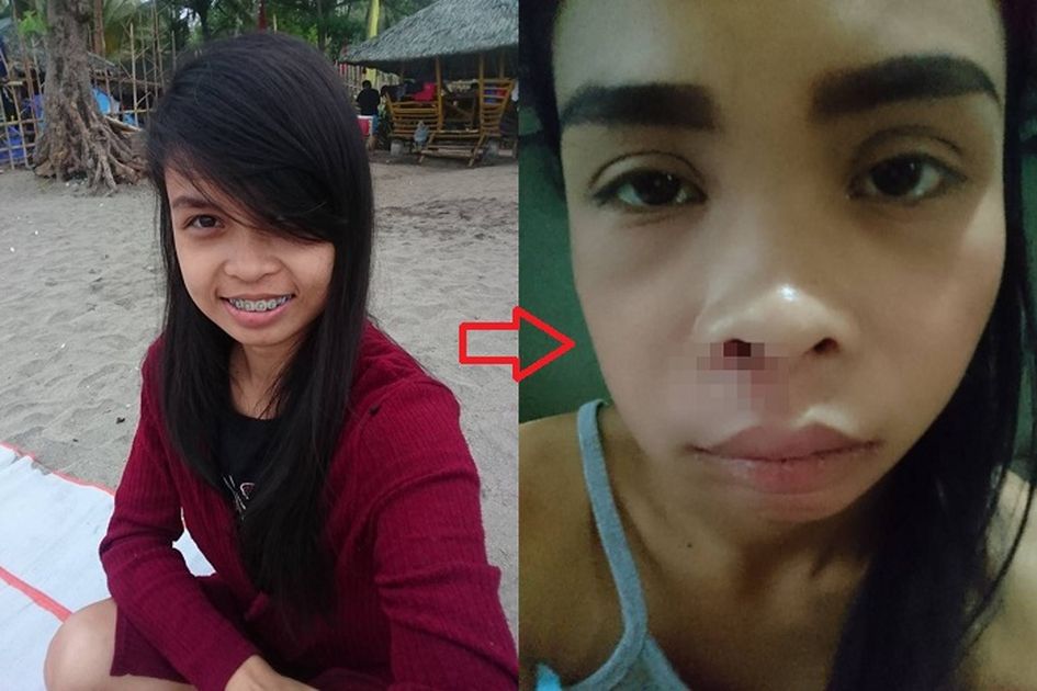 Tak Sengaja Pecahkan Jerawat Kecil Di Lubang Hidung Wanita Ini Alami Nasib Malang