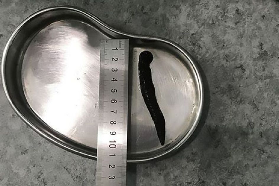 Diduga Minum Air Mentah Seekor Lintah Di Tarik Keluar Dari Tenggorokan Seorang Pria