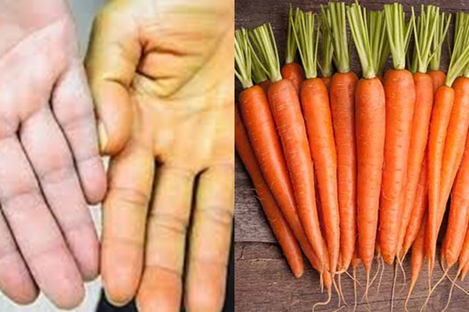 Jika Kulit Berubah Jadi Kuning Usai Makan Wortel Sebaiknya Kamu Harus Tau Hal Berikut Ini Jika Kulit Berubah Jadi Kuning Usai Makan Wortel Sebaiknya Kamu Harus Tau Hal Berikut Ini