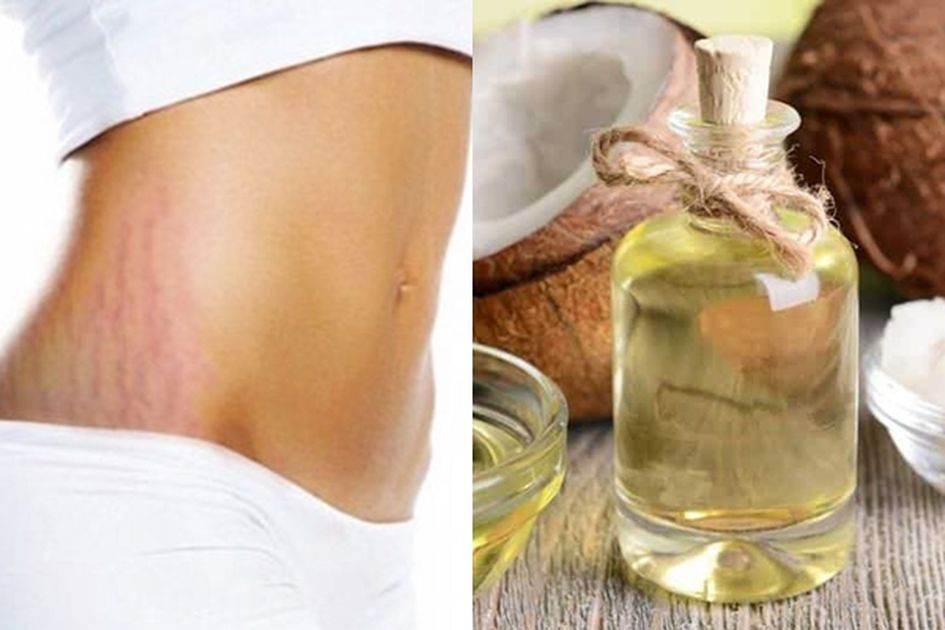 Begini Cara Cepat Menghilangkan Stretch Mark Dengan Minyak Kelapa