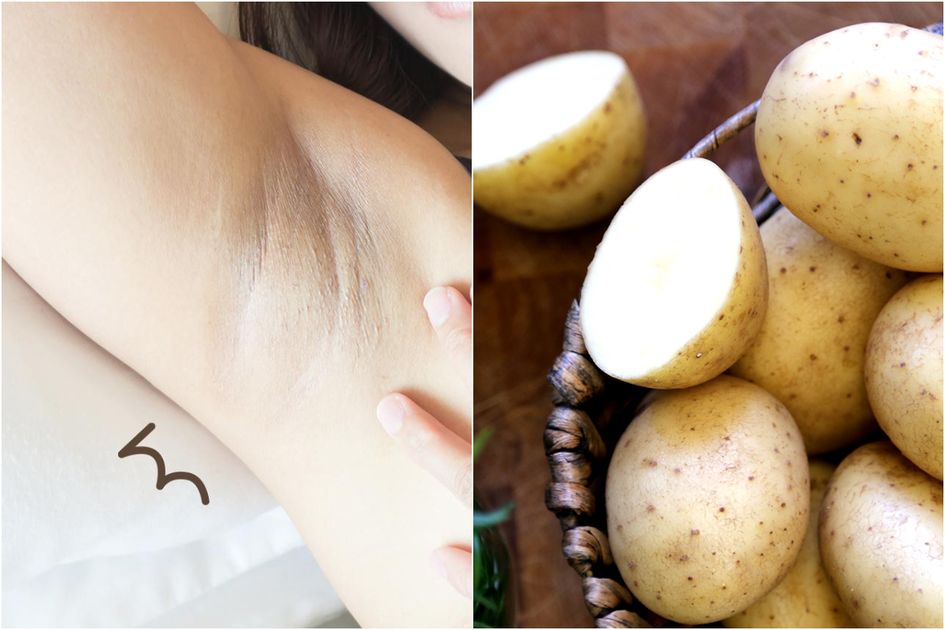 Ketiak Putih Mulus Dengan Kentang Bahan Alami Yang Ampuh Atasi Kulit Menghitam