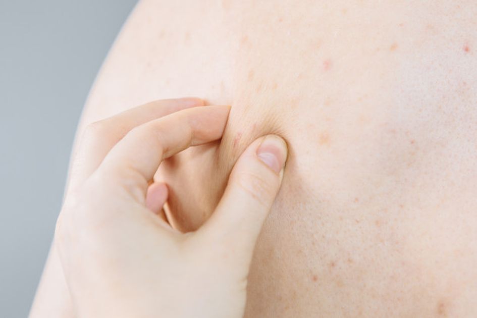 Tujuh Tips Ampuh Menghilangkan Jerawat Di Punggung Secara Alami Udah Kamu Coba