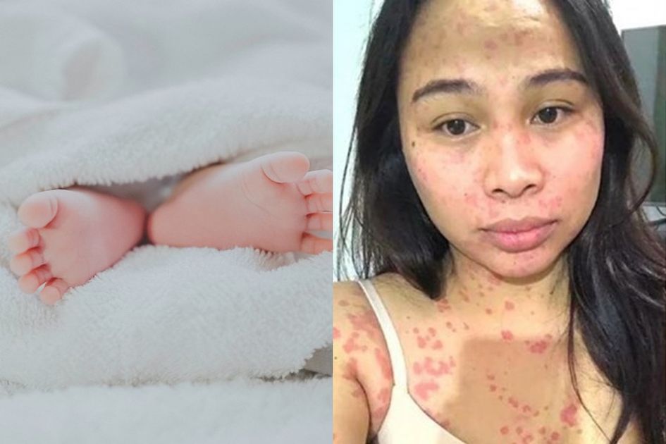 Ibunya Pakai Obat Pemutih Abal Abal Anaknya Yang Masih Bayi Alami Kondisi Mengerikan Ini