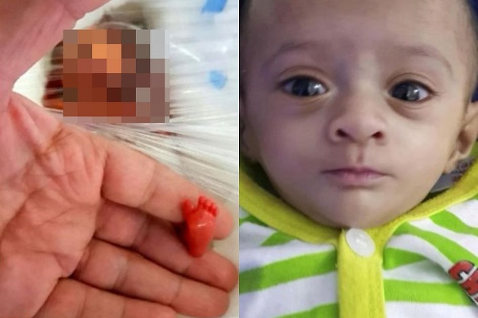 Bayi Mungil Ini Lahir Hanya Sebesar Telapak Tangan Orang Dewasa