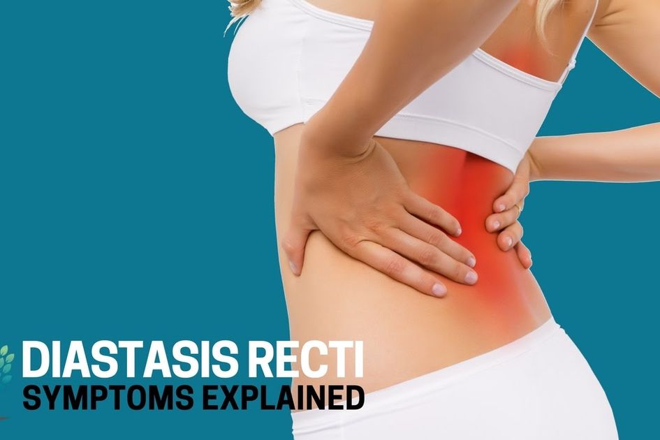 Kenali Penyebab Diastasis Recti Bisa Diprediksi Sejak Sebelum Masa Kehamilan Memangnya Seperti Apa Sih