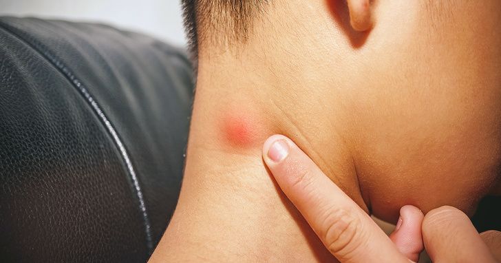 Miliki Benjolan Di Beberapa Bagian Tubuh Apakah Itu Tanda Infeksi Atau Kanker Begini Cara Mencari Tahunya Semua Halaman Intisari