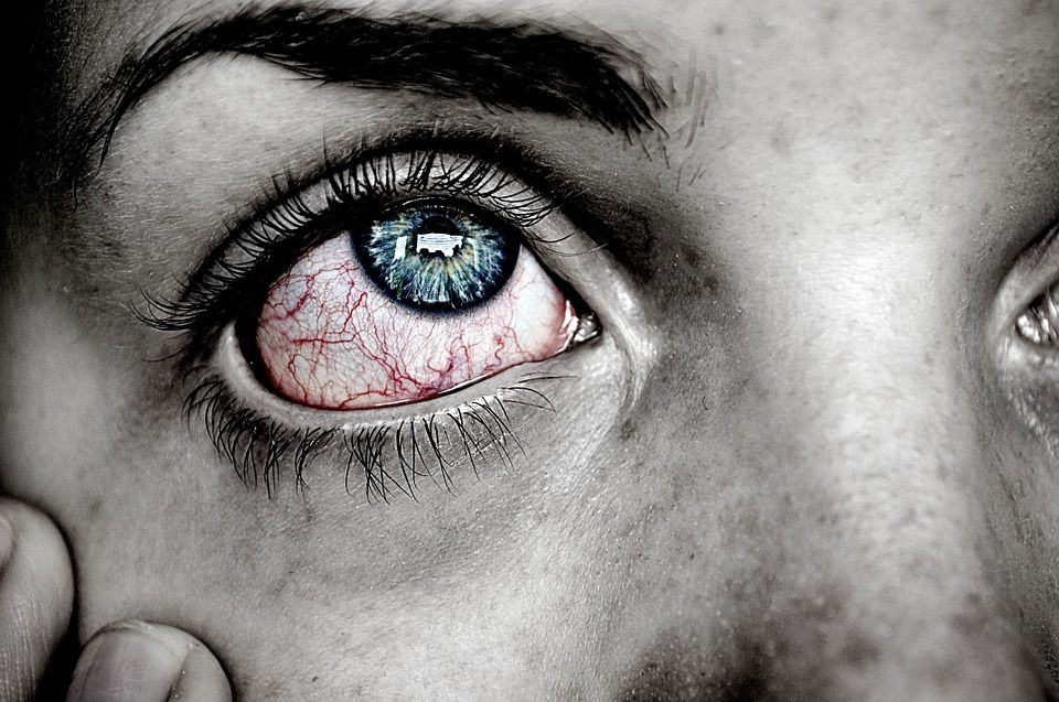 3 Penyebab Konjungtivitis, Infeksi yang Membuat Bola Mata Putih Menjadi  Merah - Semua Halaman - Grid Health