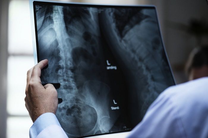 HatiHati, Osteoporosis yang Banyak Dialami Orang Tua Juga Bisa Dialami