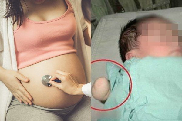 Gara Gara Air Ketuban Sedikit Tangan Bayi Malang Ini Terputus Di Dalam Rahim Sang Ibu