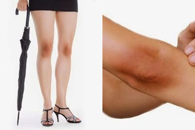 5 Cara Mudah Mengatasi Lutut Dan Siku Yang Hitam Beauty Fimela Com