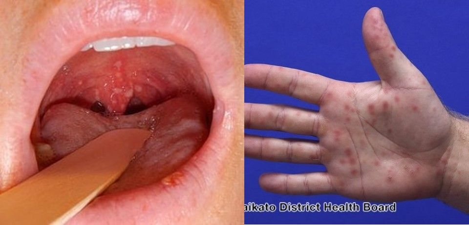 2. Gejala awal Herpangina