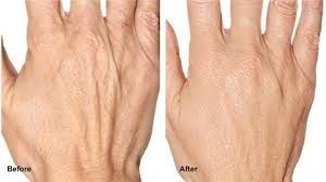 Krim Anti Keriting