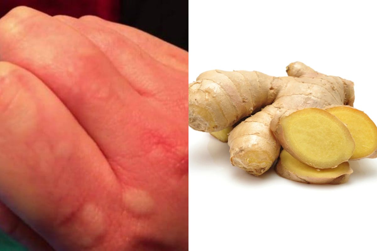 Ini Obat Biduran Herbal Yang Dikombinasikan Perawatan Rumahan Semua Halaman Intisari