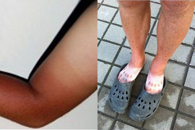 Enggak Perlu Repot Belang Di Tangan Dan Kaki Pasti Bakal Hilang Permanen Cuma Dengan 5 Bahan Alami Yang Ada Di Dapur Ini Coba Deh Semua Halaman Sajian Sedap