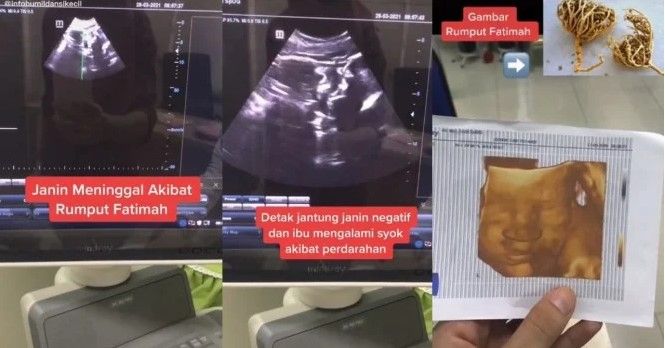 Rumput Fatimah Merenggut Nyawa Bayi Tak Berdosa Si Ibu Kritis Hingga Habiskan 20 Kantung Darah Semua Halaman Grid Health