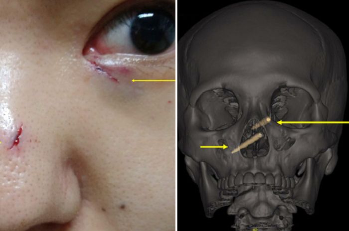 Seorang Wanita Pergi Ke Rumah Sakit Setelah Alami Luka Di Sekitar Hidung Dan Mata Dokter Memeriksa Dan Kaget Saat Tahu Ada Benda Ini Yang Tersangkut Di Dalam Tengkorak Pasiennya Semua Halaman