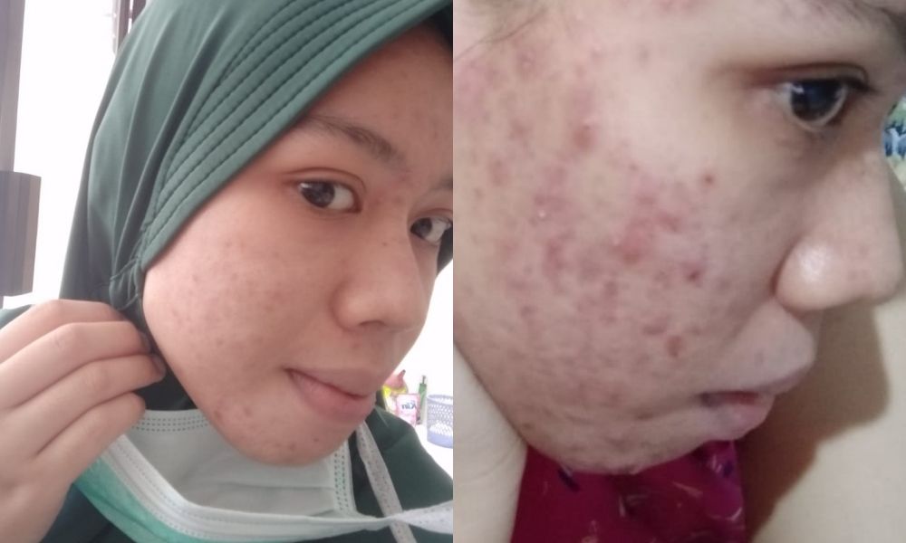 Jurnal Pejuang Jerawat Ayu Namirah Filayeti Wajah Tetap Berjerawat Meski Sudah Mencoba Berbagai Skincare Mulai Dari Yang Lokal Hingga Korea Semua Halaman Stylo