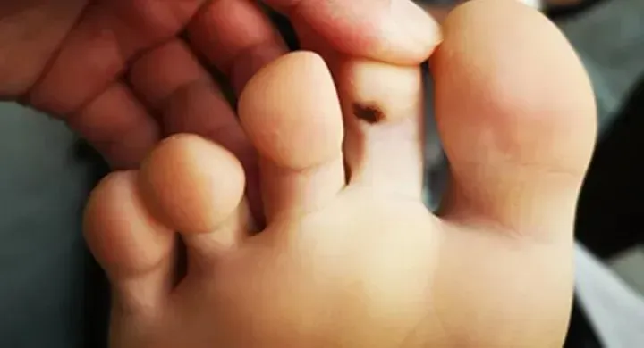 Anda Memiliki Tahi Lalat Di Telapak Kaki Apakah Pertanda Baik Kenali Watak Seseorang Berdasarkan Letak Tahi Lalat Di Tubuh Bagian Bawah Menurut Primbon Jawa Semua Halaman Intisari