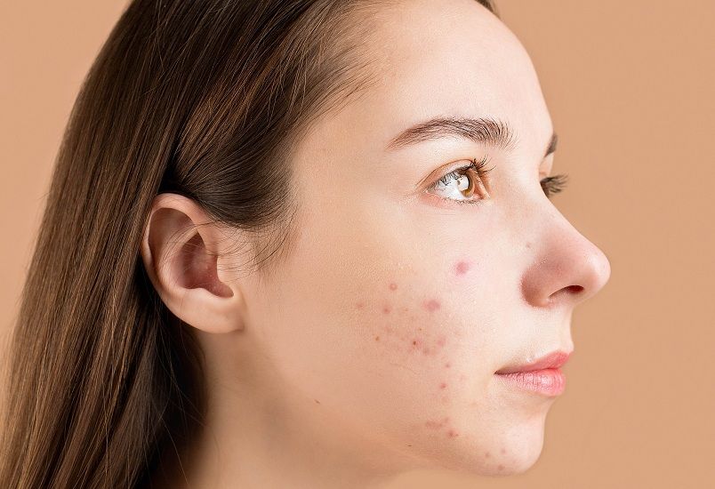 Rekomendasi skincare untuk menghilangkan bruntusan di jidat 1 Skincare untuk menghilangkan bruntusan di jidat