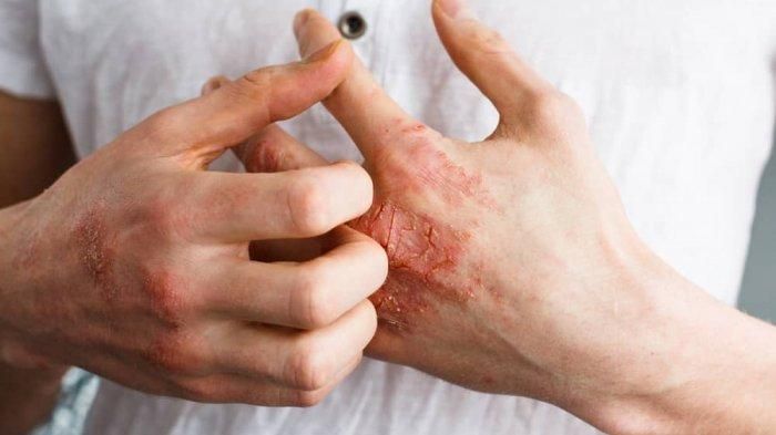 Fakta Obat herbal Untuk Mengobati Penyakit Autoimun Kulit, Semisal  Psoriasis - Semua Halaman - Grid Health