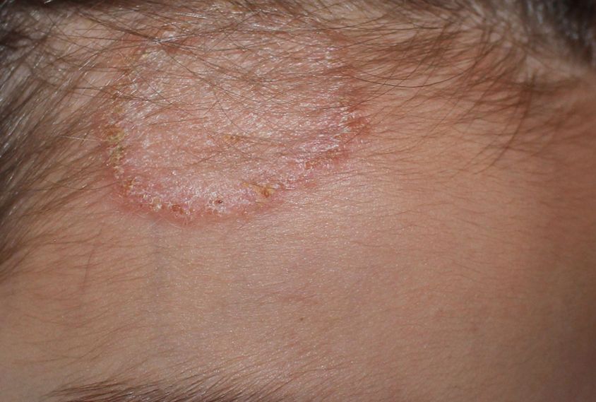 Mereka Ini Berisiko Terkena Kurap Di Kulit Kepala Ini Cara Mencegahnya Semua Halaman Grid Health